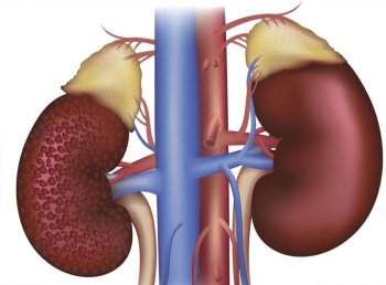 نفروپاتی دیابتی چیست