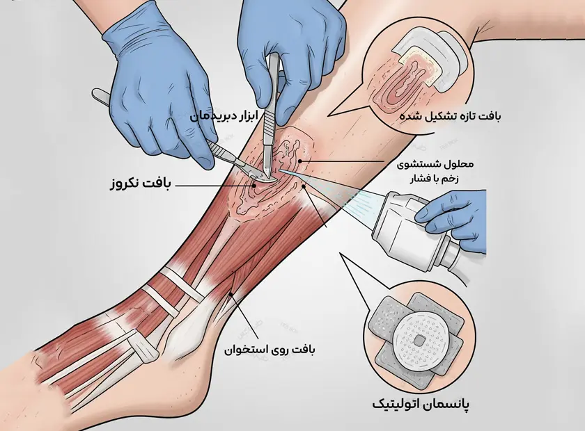 تصویر گرافیکی از مراحل دبریدمان زخم توسط متخصص