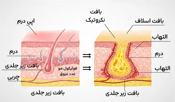 نمودار مقایسه بافت سالم و نکروزه در زخم برای درک بهتر لزوم دبریدمان