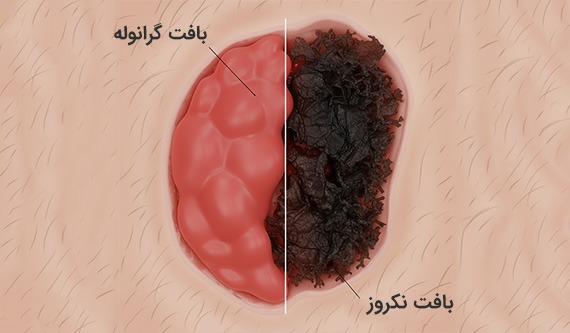 بافت گرانوله و نکروز