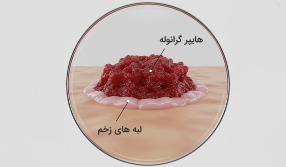 بافت هایپر گرانوله 