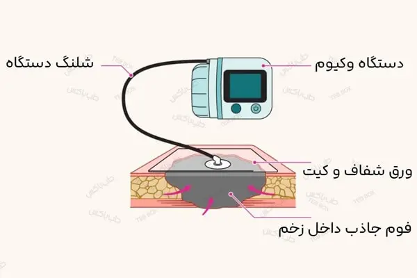 وکیوم تراپی چگونه کار می کند