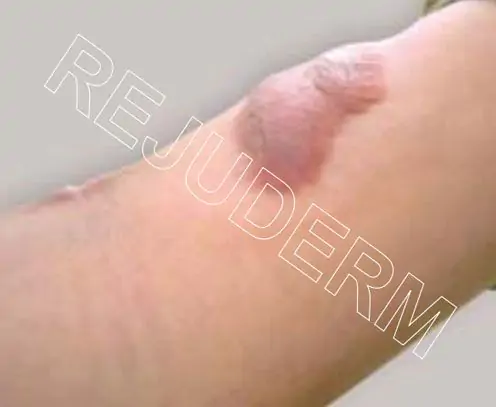 اسکار برجسته روی بازو