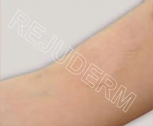 تاثیر رژودرم در مدت 18 ماه