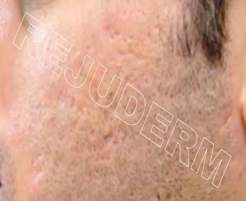 اسکار ناشی از جوش روی گونه