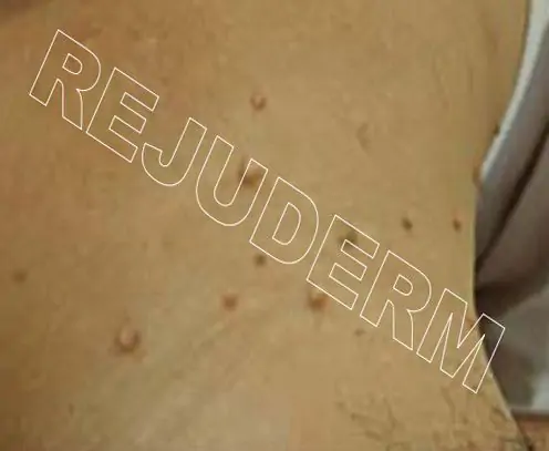 زائده گوشتی پشت گردن